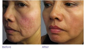 microneedling 1