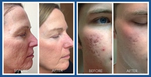 microneedling 4