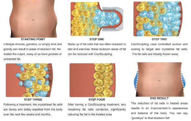 coolsculpting elite
